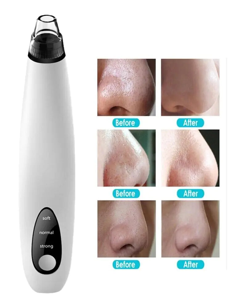 Electric Blackhead Remover Cleaner Face Diamond Pore Vacuum Suction White Heads